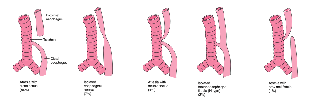 5 tipi di atresia esofagea