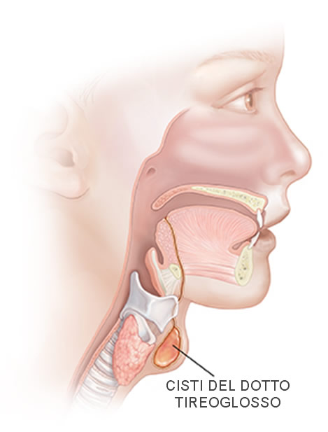 Cisti mediana del collo