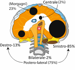 ernia diaframmatica