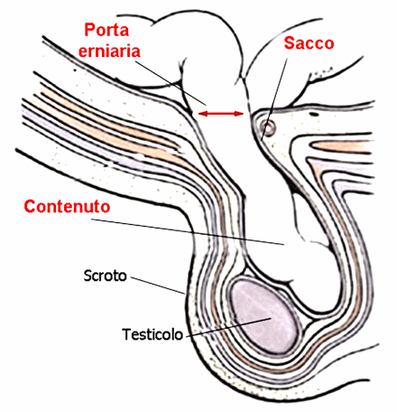 ernia inguinale