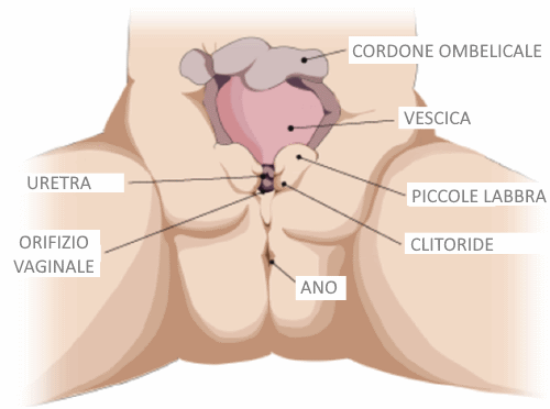 epispadia nelle bambine