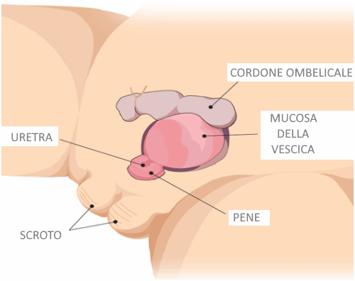 epispadia nei bambini