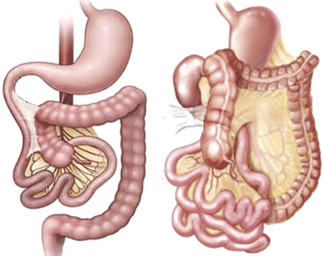 malformazioni intestinali nei neonati