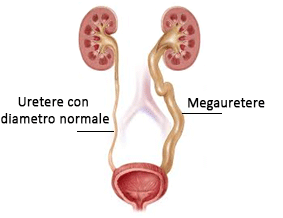 uretere con diametro normale e megauretere