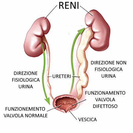 reflusso vescico ureterale