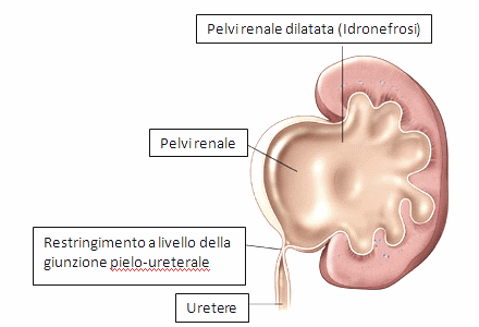 stenosi del giunto pielo ureterale